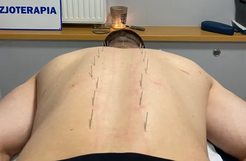 Szereg igieł akupunkturowych wzdłuż kręgosłupa pacjenta