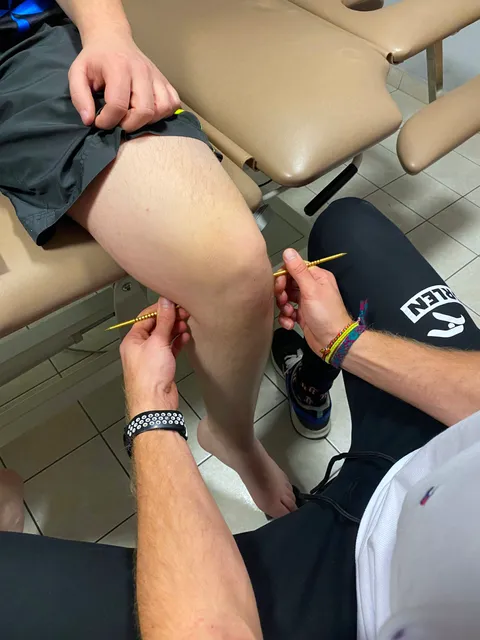 Igłoterapia sucha na punktach spustowych kolana