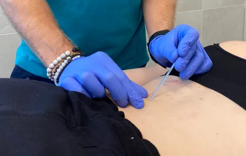 Paweł wprowadza igłę w punkt spustowy w okolicy lędźwiowej